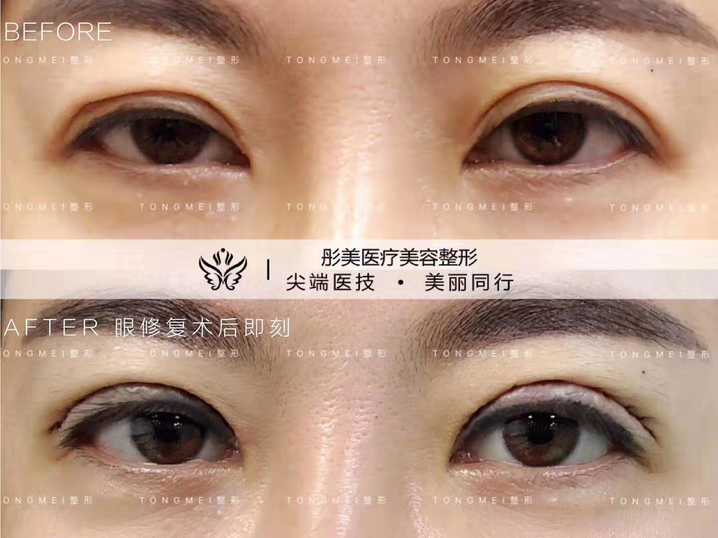 北京刘风卓割双眼皮和双眼皮修复案例效果图