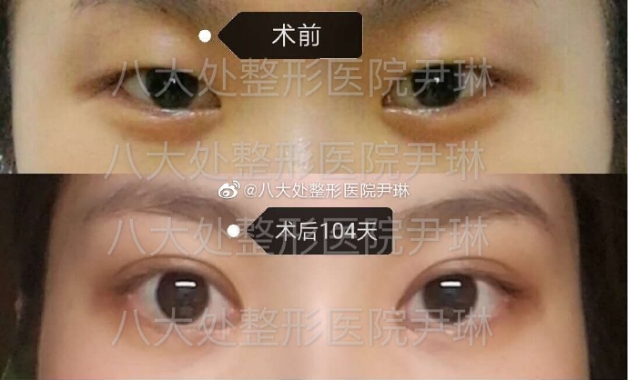 尹琳双眼皮案例