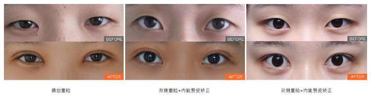 北京八大处宋涛做双眼皮技术怎么样？