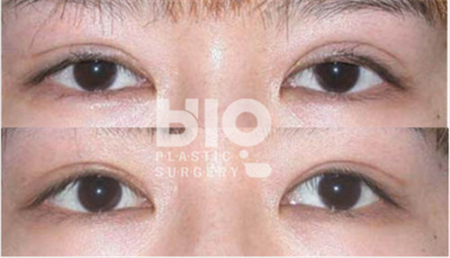广州做双眼皮修复的医生哪个最好？收费贵不贵？