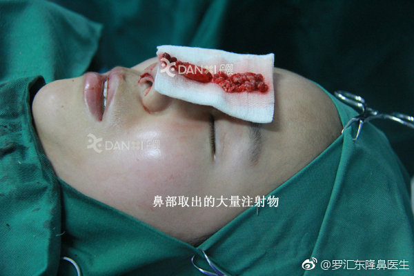 北京哪位医生擅长做鼻部注射物取出手术？