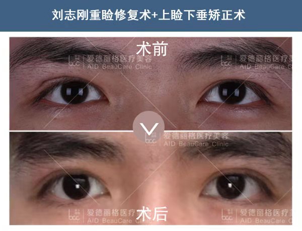 大连双眼皮修复专家刘志刚技术好不好？
