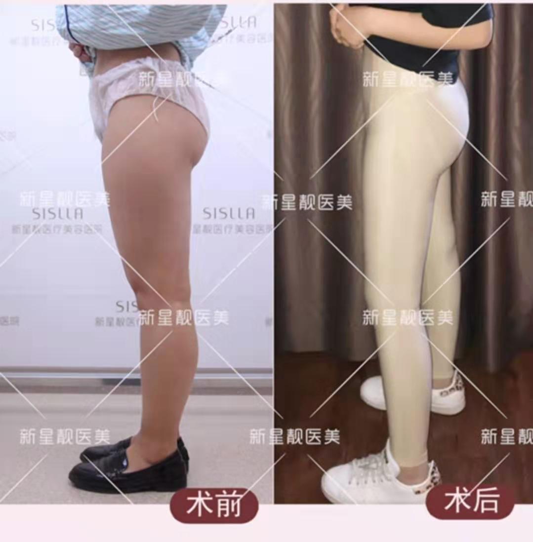 北京张立彬、李京霖、任学会、王明利、张准哪个医生做大腿抽脂好？