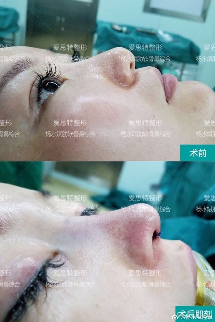 武汉杨水斌医生做鼻子技术好不好？有没有案例？