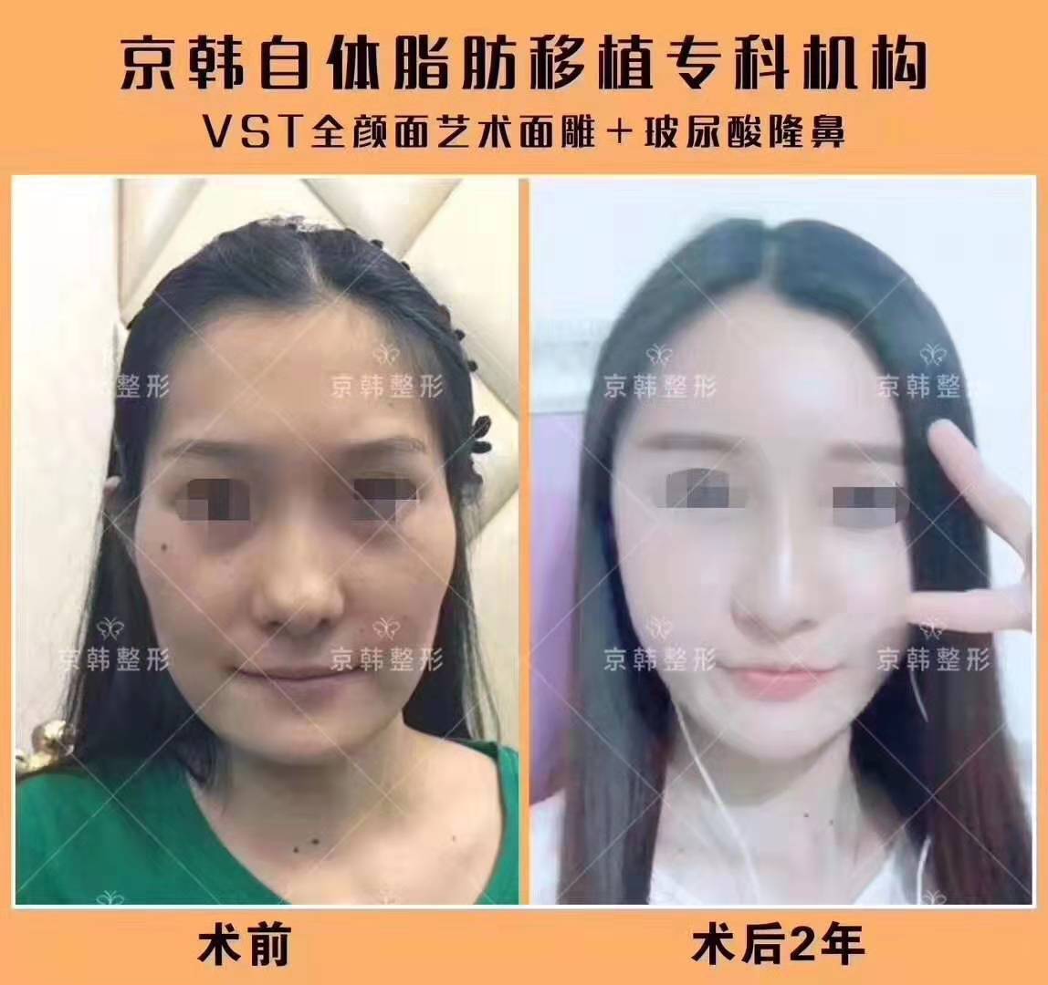 北京哪个专家做面部精雕最好？价格贵不贵？