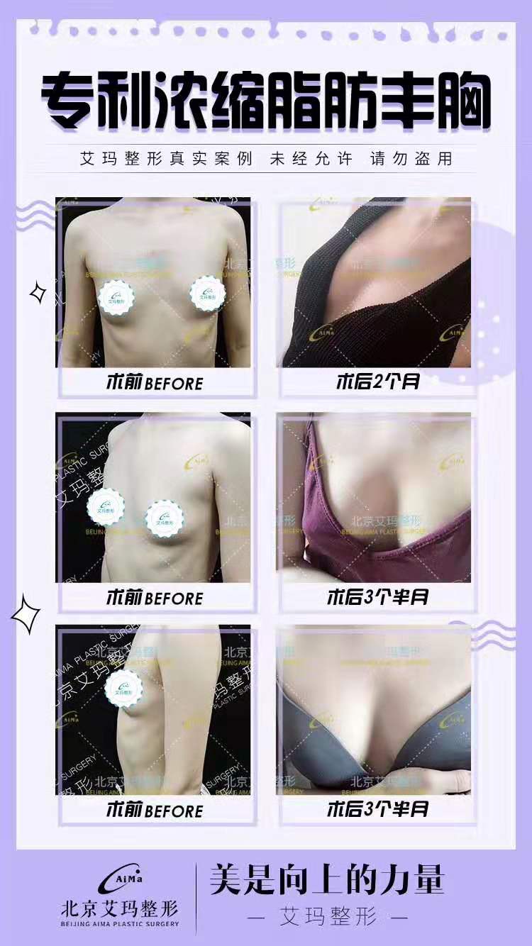 北京艾玛脂肪丰胸多少钱，韦元强的技术可以吗？