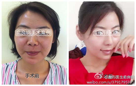 上海俞良钢改脸型技术怎么样，大概收费多少钱？