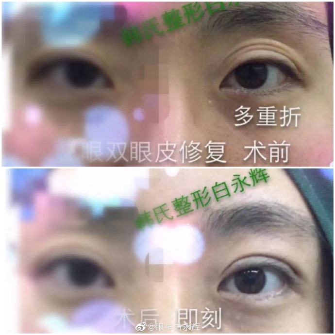 白永辉和高亮修复双眼皮谁更好？
