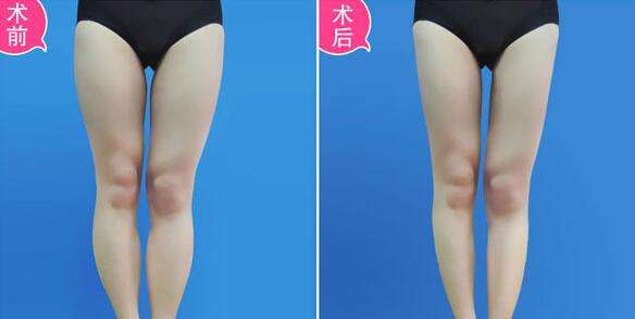 北京大腿吸脂哪个医生性价比高？王志坚和李京霖哪个技术好？