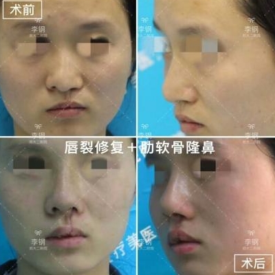 李钢医生做鼻修复和鼻综合技术好吗？