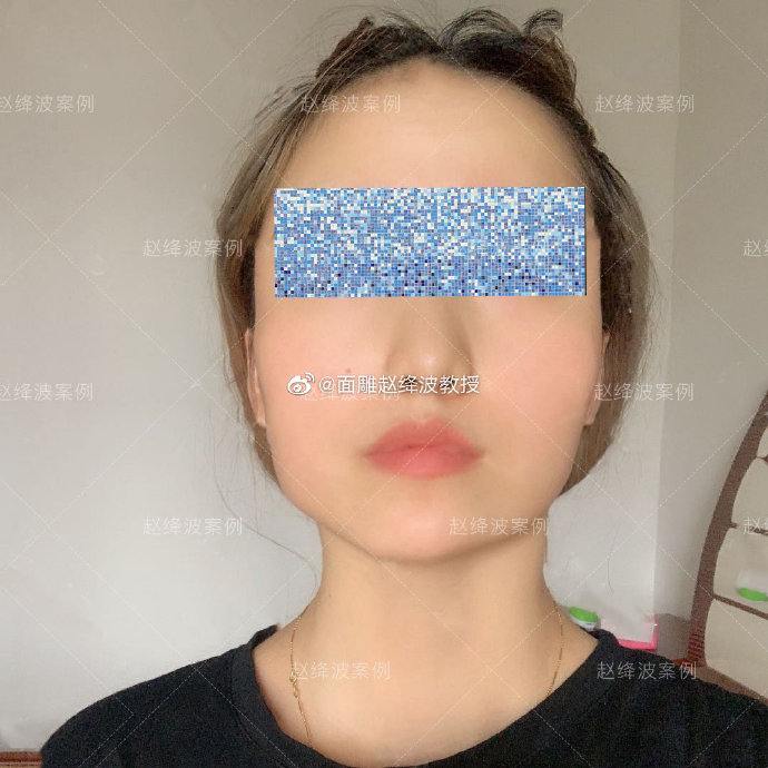赵绛波医生做磨骨下颌角改脸型技术靠谱吗？