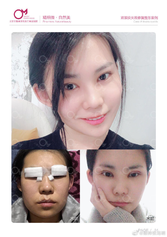张海明双眼皮修复案例