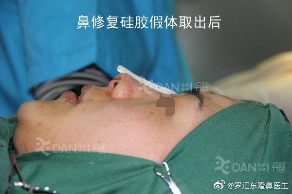 北京擅长做膨体隆鼻或膨体鼻修复的专家有哪些？