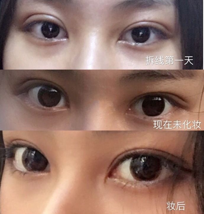 朱惠敏双眼皮修复案例