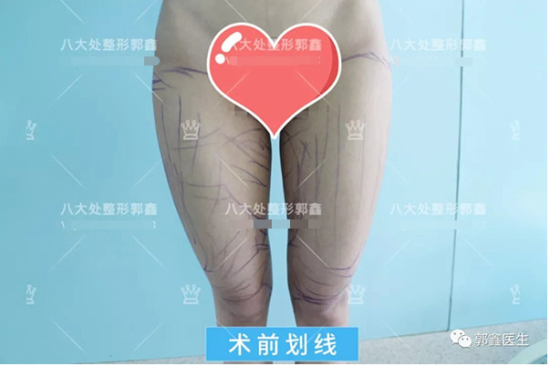 北京八大处大腿吸脂费用多少钱？哪个医生做的好？