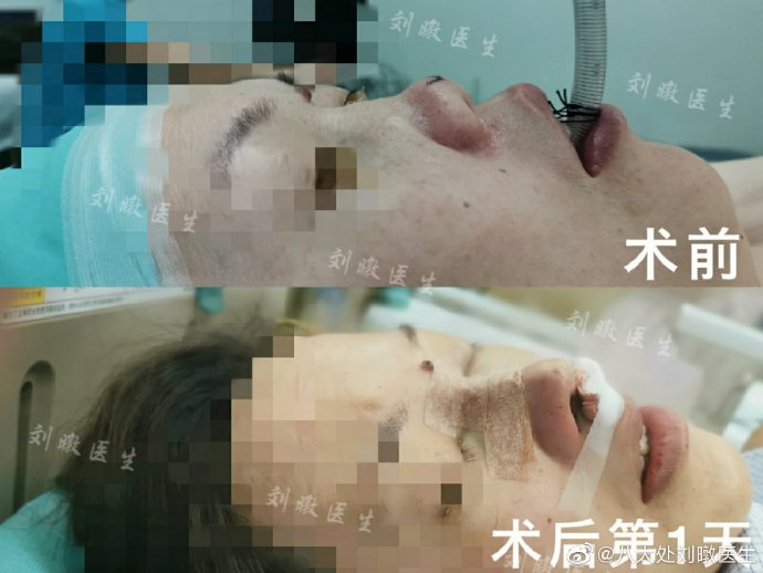 刘暾鼻综合案例