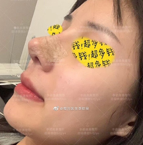 北京隆鼻专家李劲良和李长赋哪个做鼻综合效果好看？