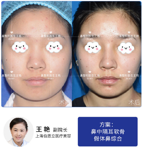 上海鼻综合最好的医生，上海鼻综合大概多少钱？