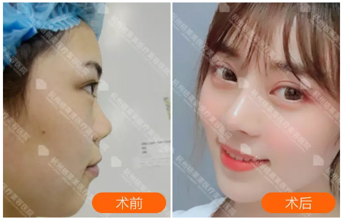 杭州鼻修复专家哪个口碑最好？