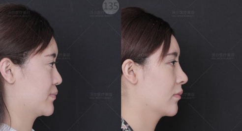 北京哪个医生做鼻子最好？