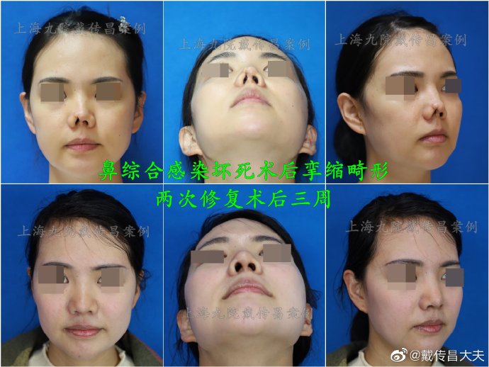 上海九院鼻子修复最出名的医生是谁？