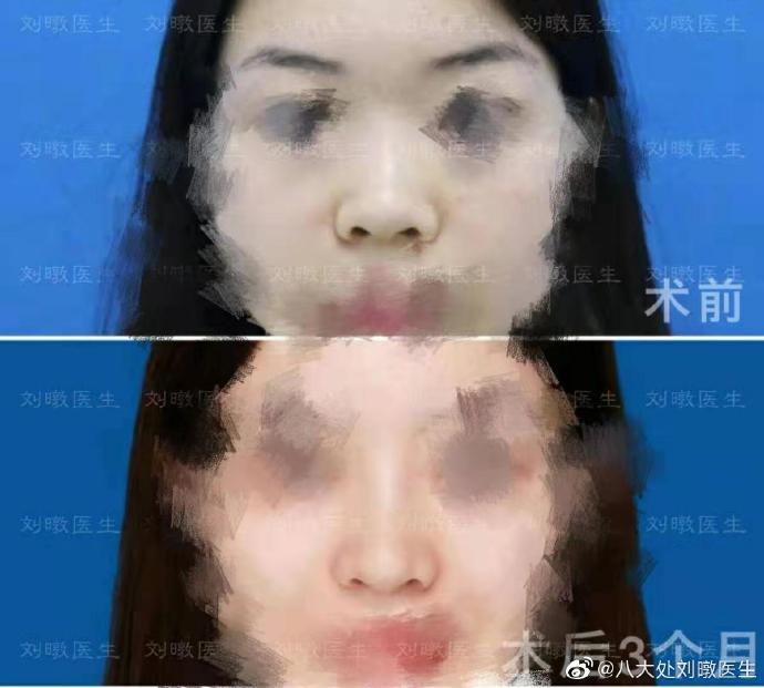 北京最厉害的隆鼻医生是谁？