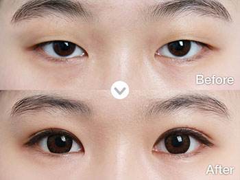 天津双眼皮修复专家是谁？