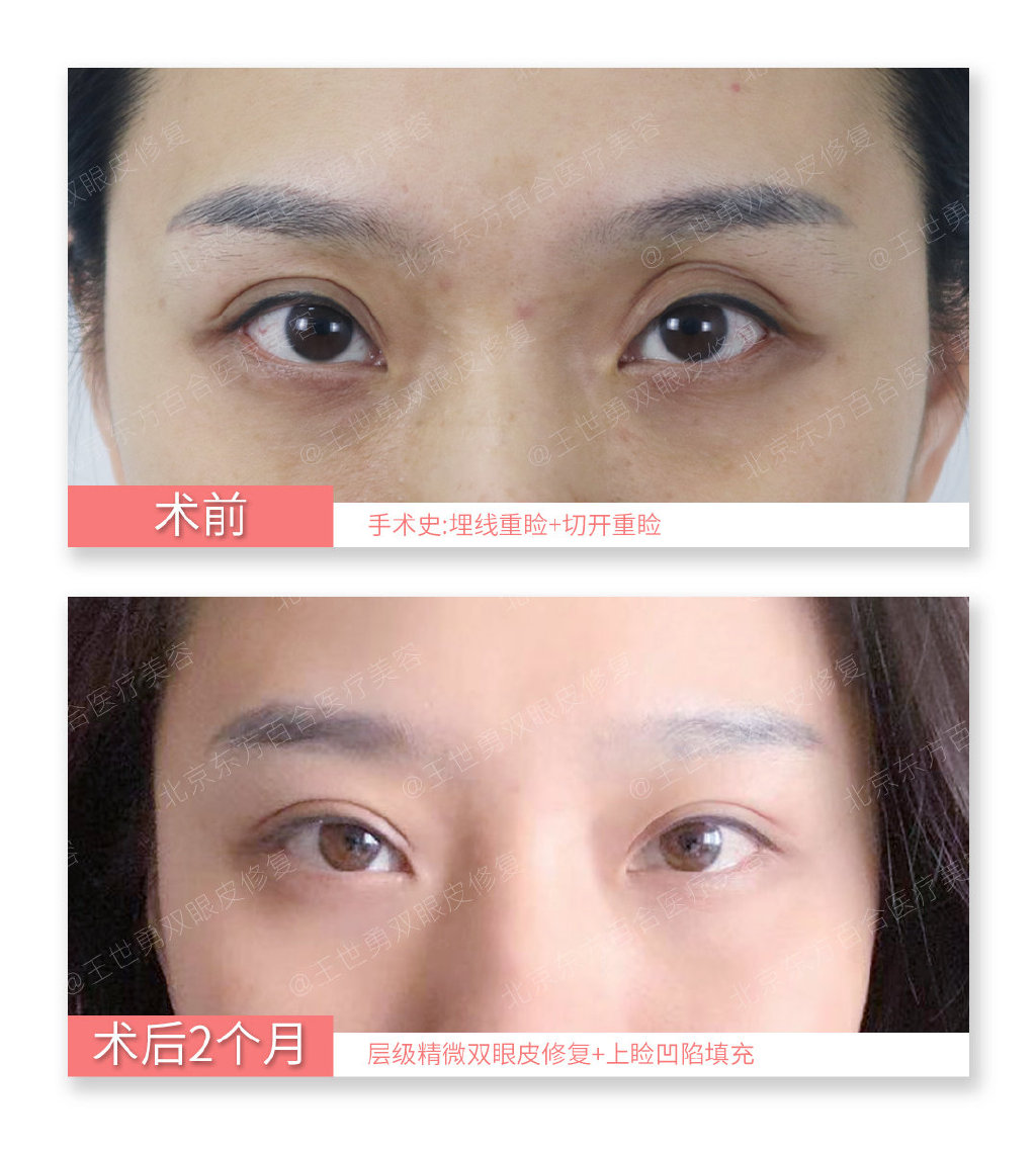 北京知名双眼皮修复专家是哪个？