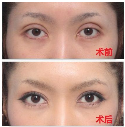 深圳双眼皮修复哪位医生比较好，深圳双眼皮修复专家排行榜