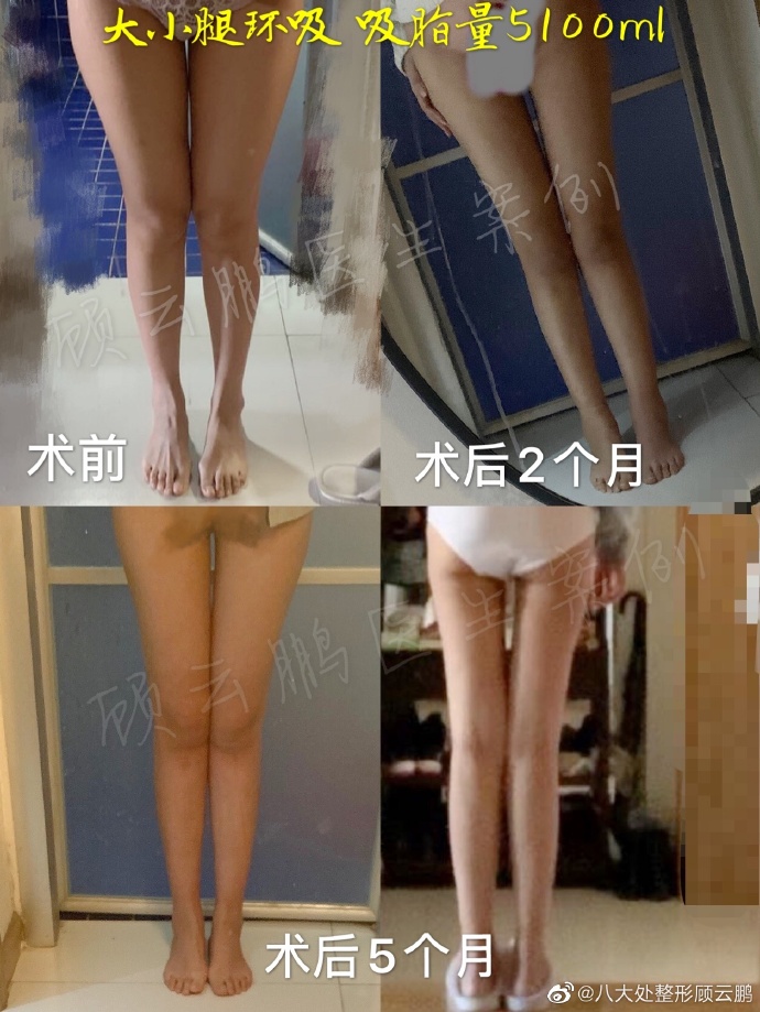 北京八大处大腿吸脂医生哪个好？