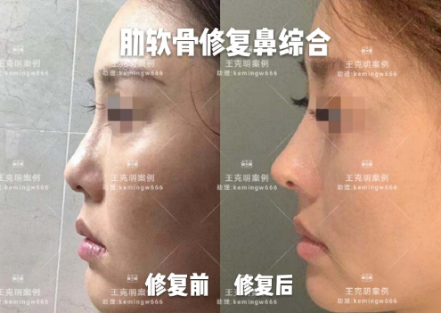 北京八大处鼻子整形修复专家