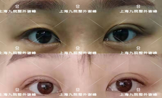 上海九院谁双眼皮修复做得好？上海双眼皮修复医生预约排名