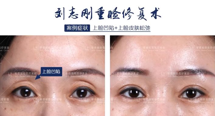 大连刘志刚高难度双眼皮修复案例在线预约