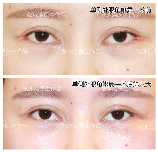 北京修复双眼皮的女医生