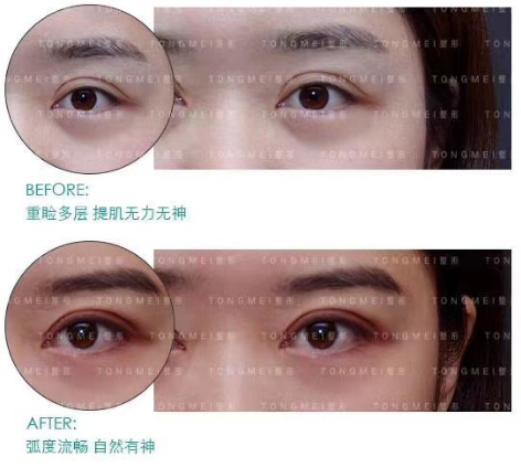 北京双眼皮修复专家刘风卓案例
