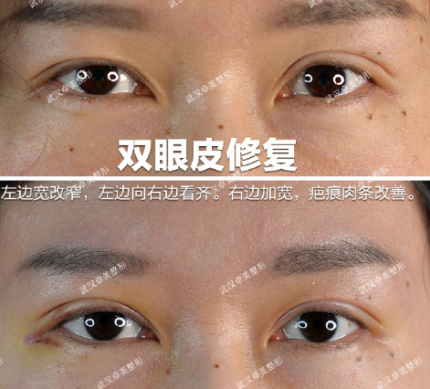 武汉王海平双眼皮修复技术怎么样