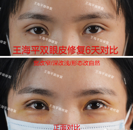 武汉做双眼皮修复最好的医生 武汉眼修复专家预约排行榜