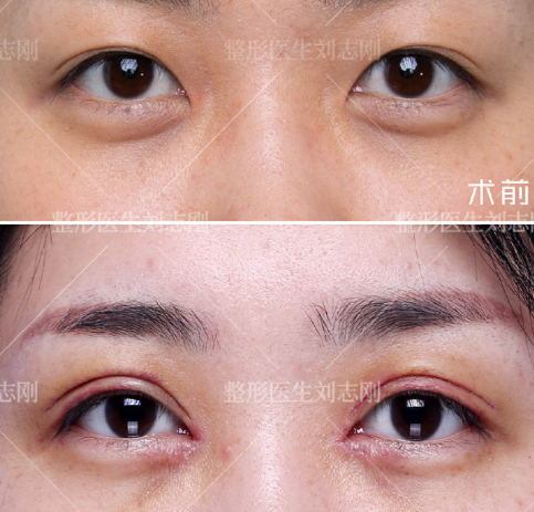 西安双眼皮修复最好的医生 西安眼修复专家排行榜预约
