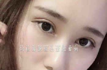 北京邦定刘桂莲割双眼皮技术怎么样