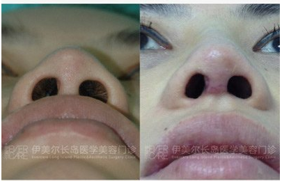袁志玮鼻综合案例好看吗，隆鼻技术怎么样