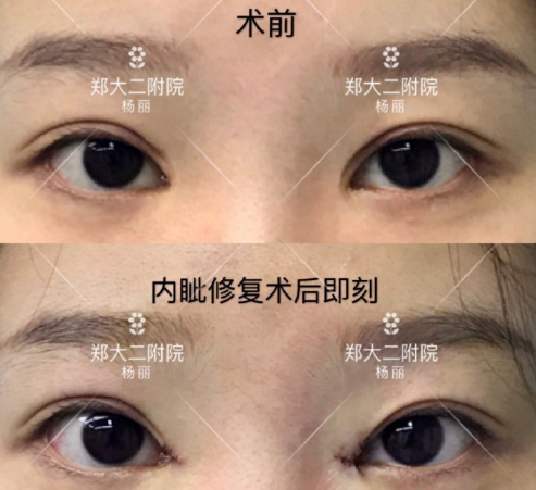 郑州双眼皮修复哪个医生比较好