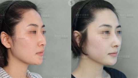 中国最好的鼻子修复整形医生