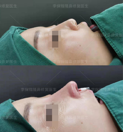 李保锴鼻修复案例