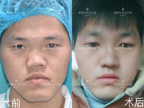 上海做畸形鼻修复的医生哪个好