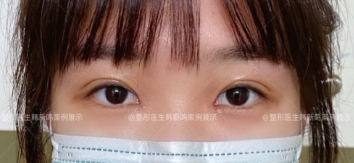 北京最好的整形医院双眼皮医生