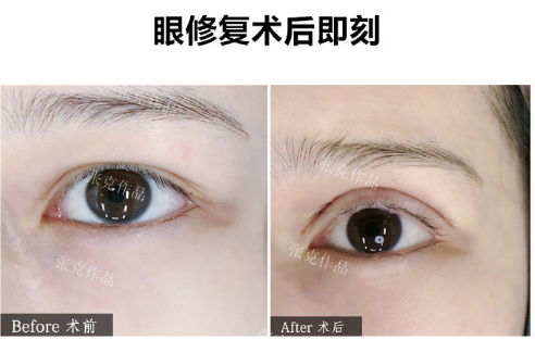 广州张克双眼皮修复技术怎么样