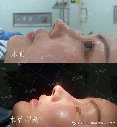 邓东伟鼻修复案例