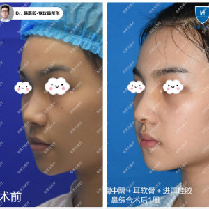 上海做鼻子哪个医生做得好？上海隆鼻医生预约排行榜