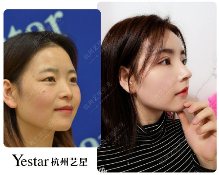 杭州最好的鼻子修复专家是谁