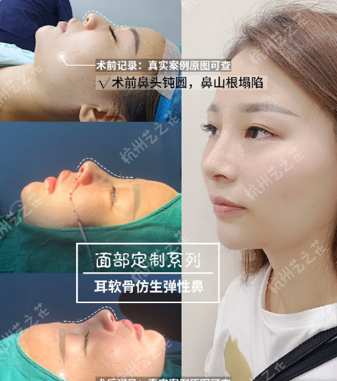杨海波鼻修复案例